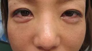 眼の下の二重の術後