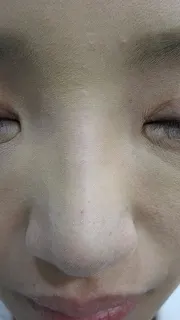 隆鼻術のヒアルロン酸注入後