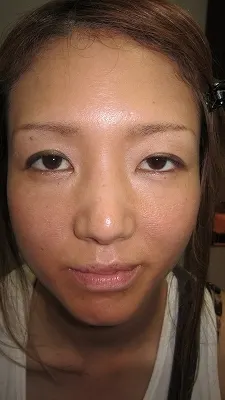 口唇のヒアルロン酸の注入前