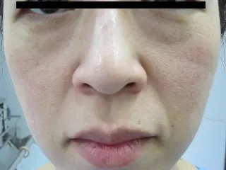 眼の下のタルミ治療