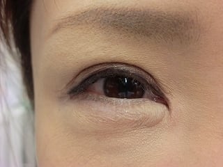 二重瞼（全切開法）の術後