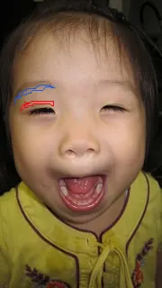 上眼瞼タルミ取り