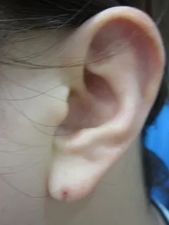 ピアス後の耳垂裂の術前