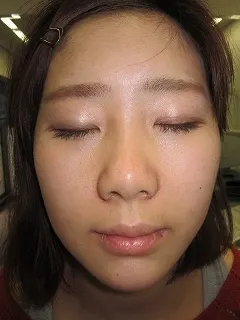 鼻翼縮小の術後