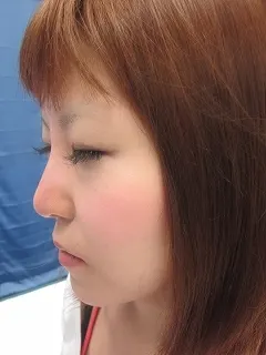 鼻　レディエッセの治療後