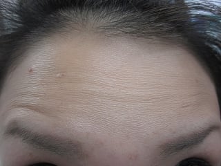 額、眉間、顎の表情ジワの注射前