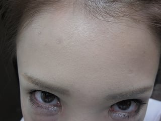 額、眉間、顎の表情ジワの注射後