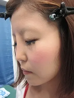 鼻　レディエッセの治療前