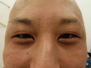 二重瞼の施術前