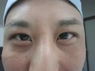 二重瞼の施術後