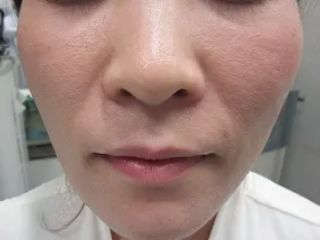 ほうれい線のヒアルロン酸注入前