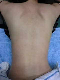 ダーマローラー（毛孔性苔癬）の施術前