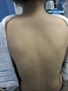 ダーマローラー（毛孔性苔癬）の施術後