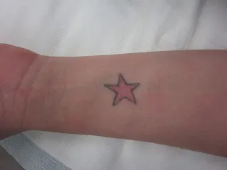 タトゥー（入れ墨）除去の術前