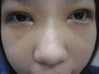 二重瞼 （切開法）、目頭切開の術後