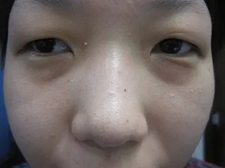 二重瞼 （切開法）、目頭切開の術前