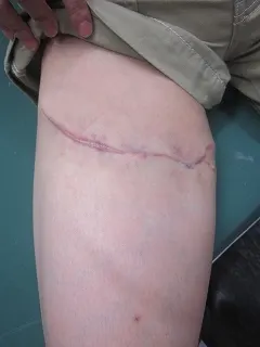 タトゥー（入れ墨）除去の術後