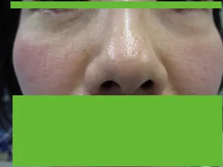 経結膜脱脂法の術後