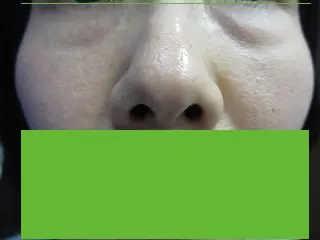 経結膜脱脂法（目の下のふくらみ取り）の術前