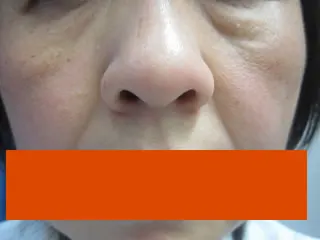 下眼瞼たるみ取り（ハムラ法）の術前