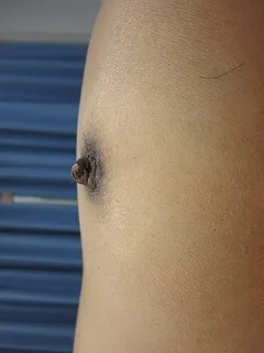 乳頭縮小（女性）の術後