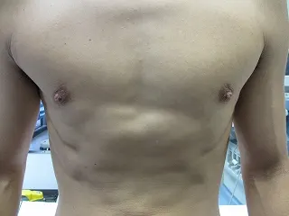乳頭縮小（男性）の術前
