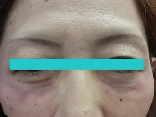 目の下たるみ取りの術前