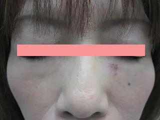 目の下たるみ取りの術後