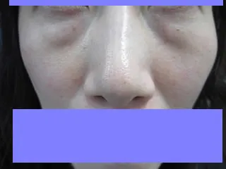 経結膜脱脂法（眼の下のふくらみ取り）の術前