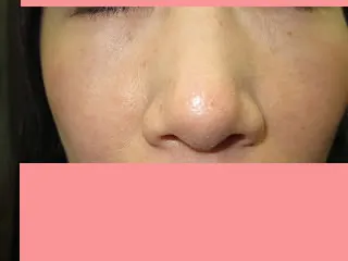 経結膜脱脂法（眼の下のふくらみ取り）の術後