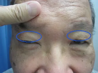 眼瞼下垂