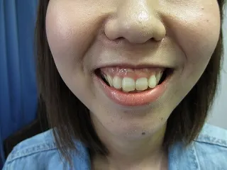 ガミースマイルの施注前