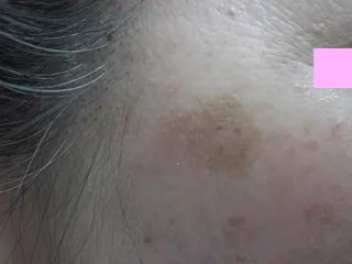 シミの治療前