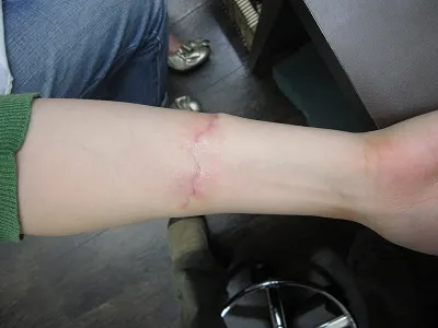 タトゥー（刺青）除去の術後