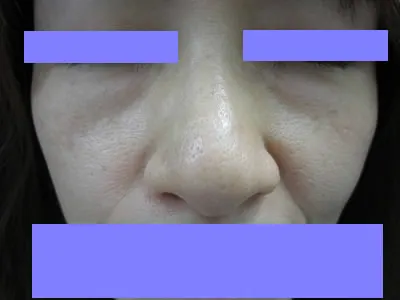 経結膜脱脂法（眼の下のふくらみ取り）の術前