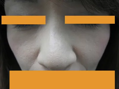 経結膜脱脂法（眼の下のふくらみ取り）の術後