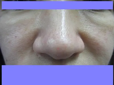 目の下タルミ取りの術前