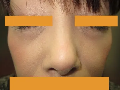 経結膜脱脂法（目の下のふくらみ取り）の術後