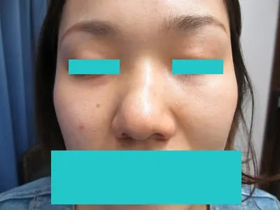 隆鼻　ヒアルロン酸の術前