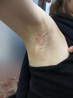 わきの傷跡修正の術後