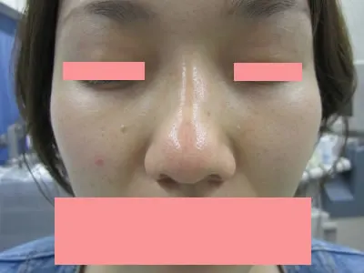 隆鼻　ヒアルロン酸の術後