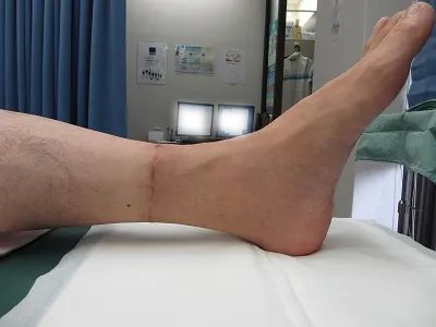 タトゥー（刺青）除去の術後