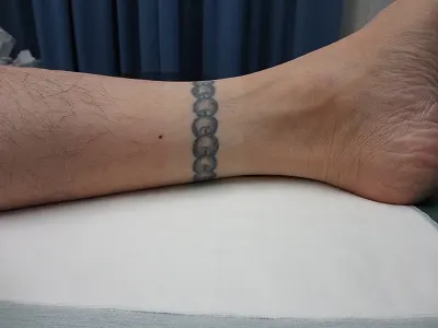 タトゥー（刺青）除去の術前