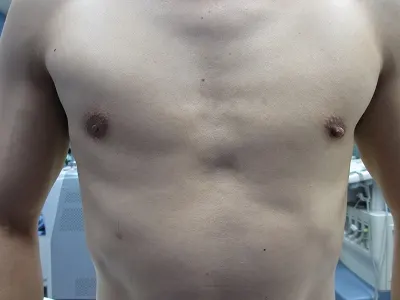 乳頭縮小（男性）の術前