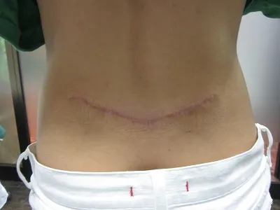 タトゥー（刺青）除去の術後