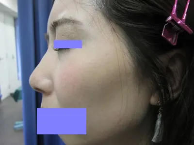 隆鼻　ヒアルロン酸の施注後