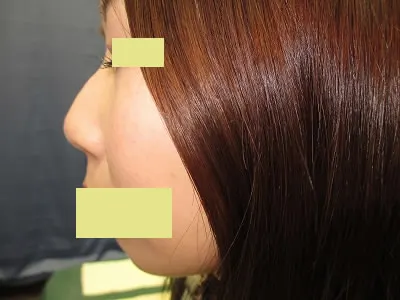 隆鼻　ヒアルロン酸の施注前