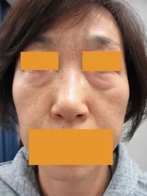 目の下のたるみ取りの術前