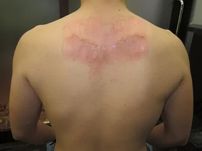 タトゥー（刺青）除去の2回目除去後