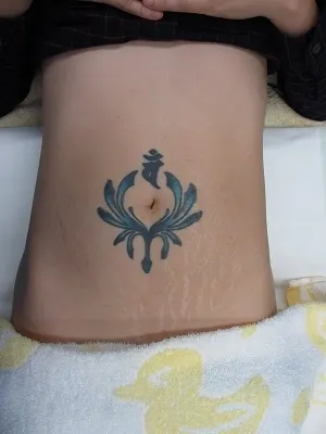 タトゥー（刺青）切除の術前